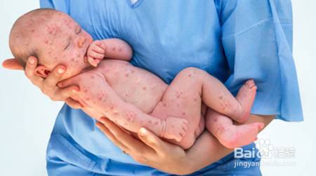宝宝湿疹,儿科医生教你快速祛湿疹