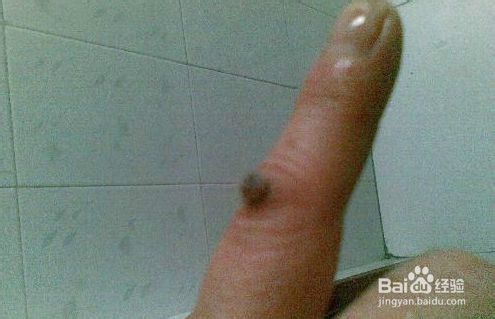 大蒜治瘊子经验分享