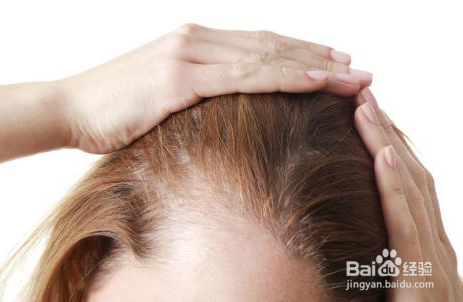 防脱经验，治疗脱发都有哪些方法，怎么选择