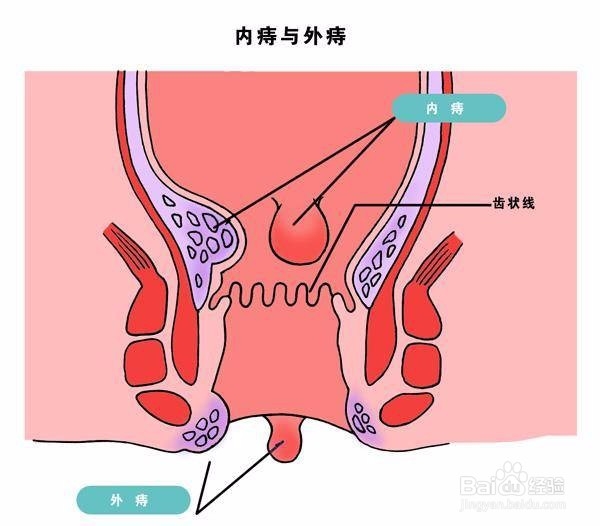 痔疮是否需要手术治疗