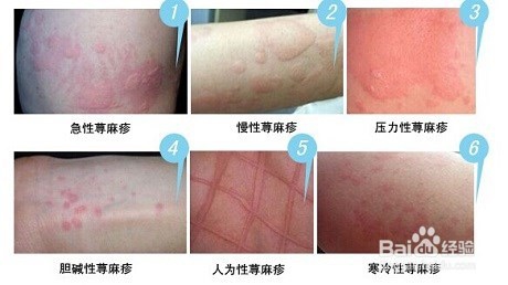 丘疹的治疗方法图片