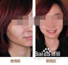 痘印怎么消除才有效？去除痘印有方法是这么简单