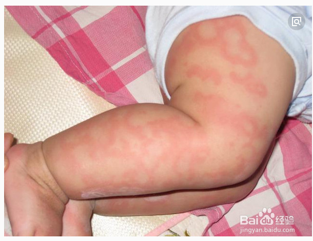 宝宝过敏怎么办?