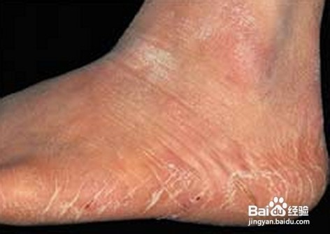 得了脚气怎么办？