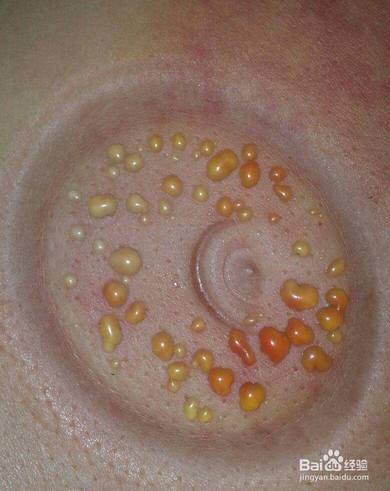 拔罐起泡怎么处理
