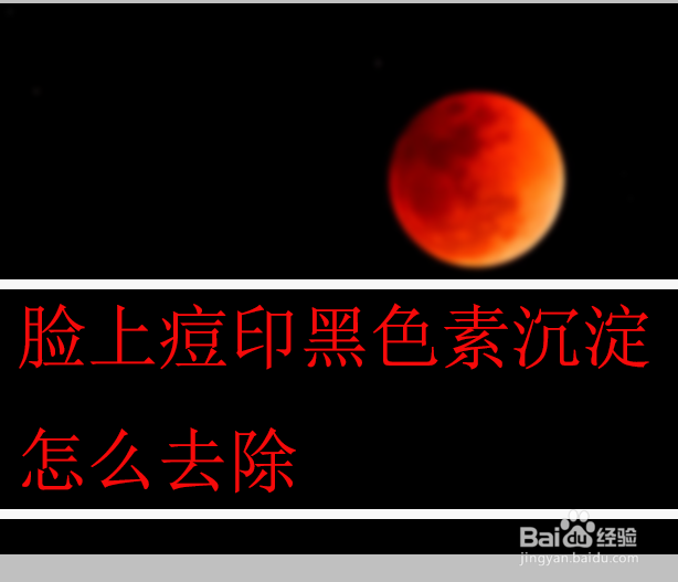 脸上痘印黑色素沉淀怎么去除