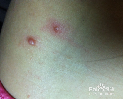 背部长痘痘的最佳办法