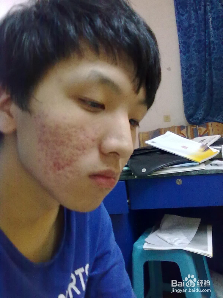 如何去脸上的痘坑