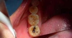 怎样简单快速的蛀牙止痛。