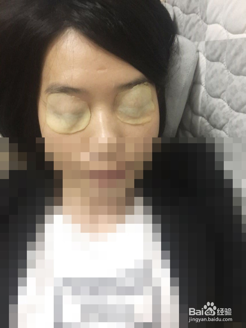 土豆片去黑眼圈