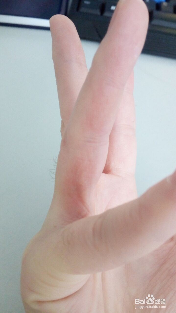 手指小水泡的治疗过程（真实经验）