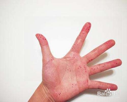 手让辣椒辣着了有什么好办法解决