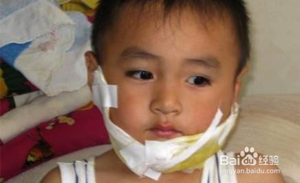 腮腺炎用仙人掌怎么敷