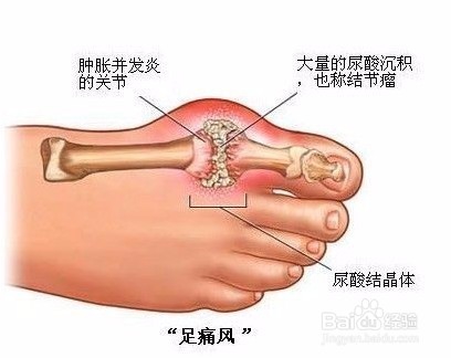 痛风治疗的四大误区