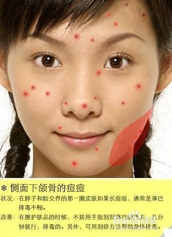 了解自己脸上的某个部位长痘痘的原因