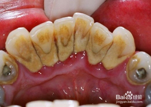 牙齿总出血怎么办?