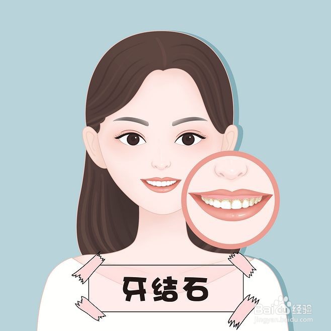 什么是牙结石？有什么危害？