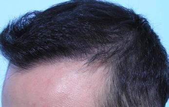 植发的寿命是多久