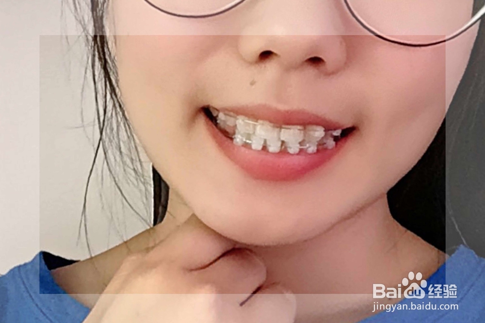 戴了牙套(矫正)要怎么清洁牙齿
