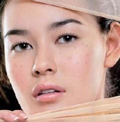 星星点点的雀斑是怎么形成的