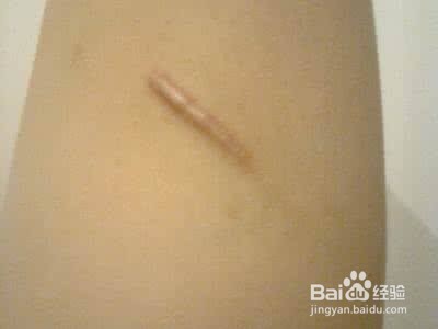 怎么祛陈年旧疤