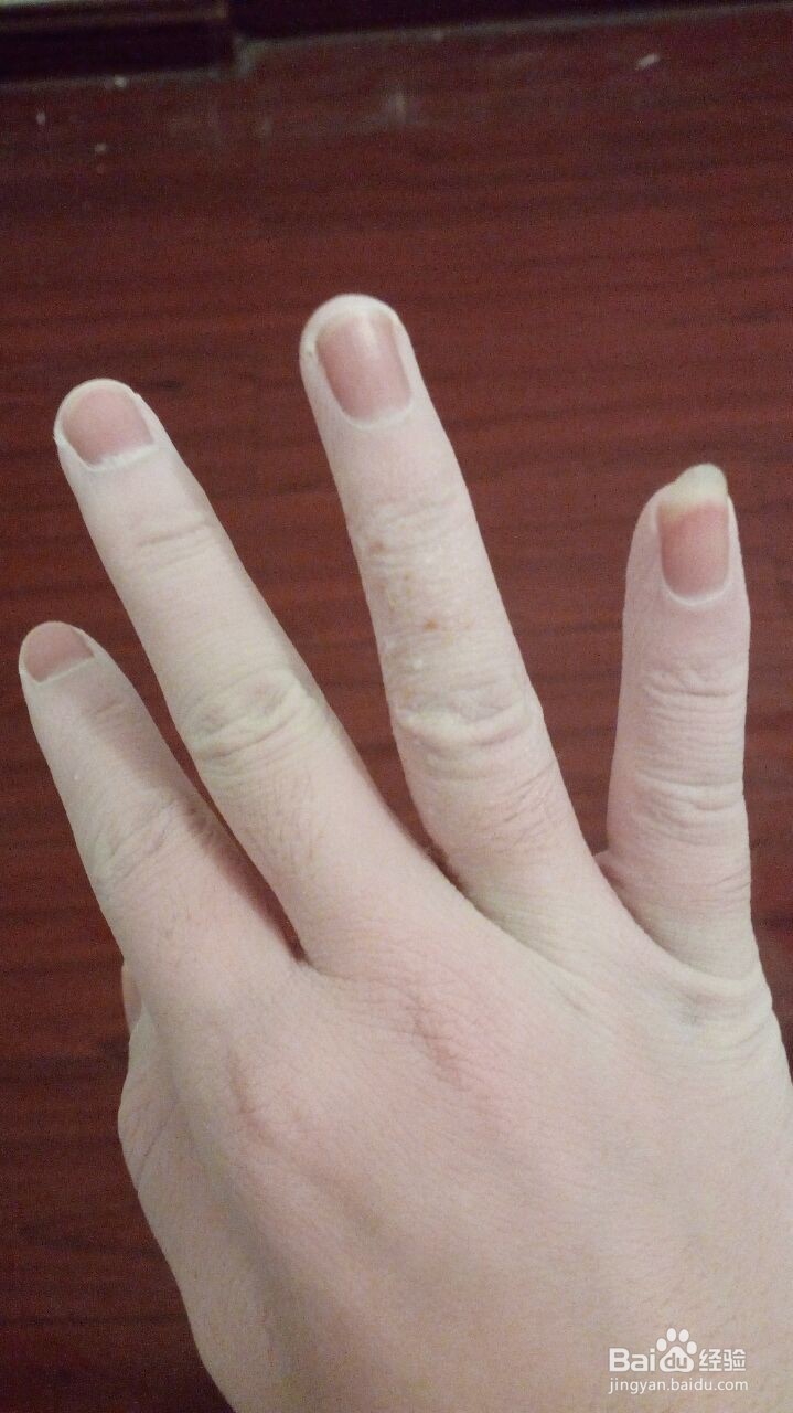 手指小水泡的治疗过程（真实经验）