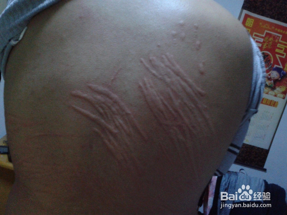 身上起红疙瘩很痒怎么办