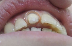 贵金属烤瓷牙优势是什么