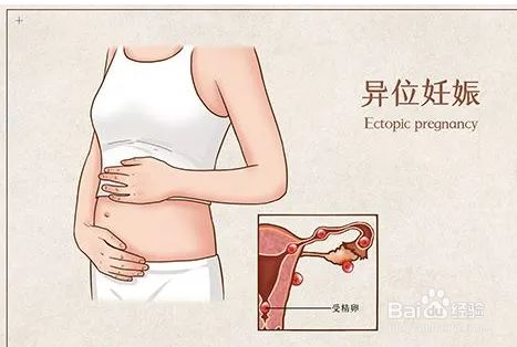 怀疑是宫外孕怎么办 百度经验 怀疑是宫外孕怎么办 百度经验