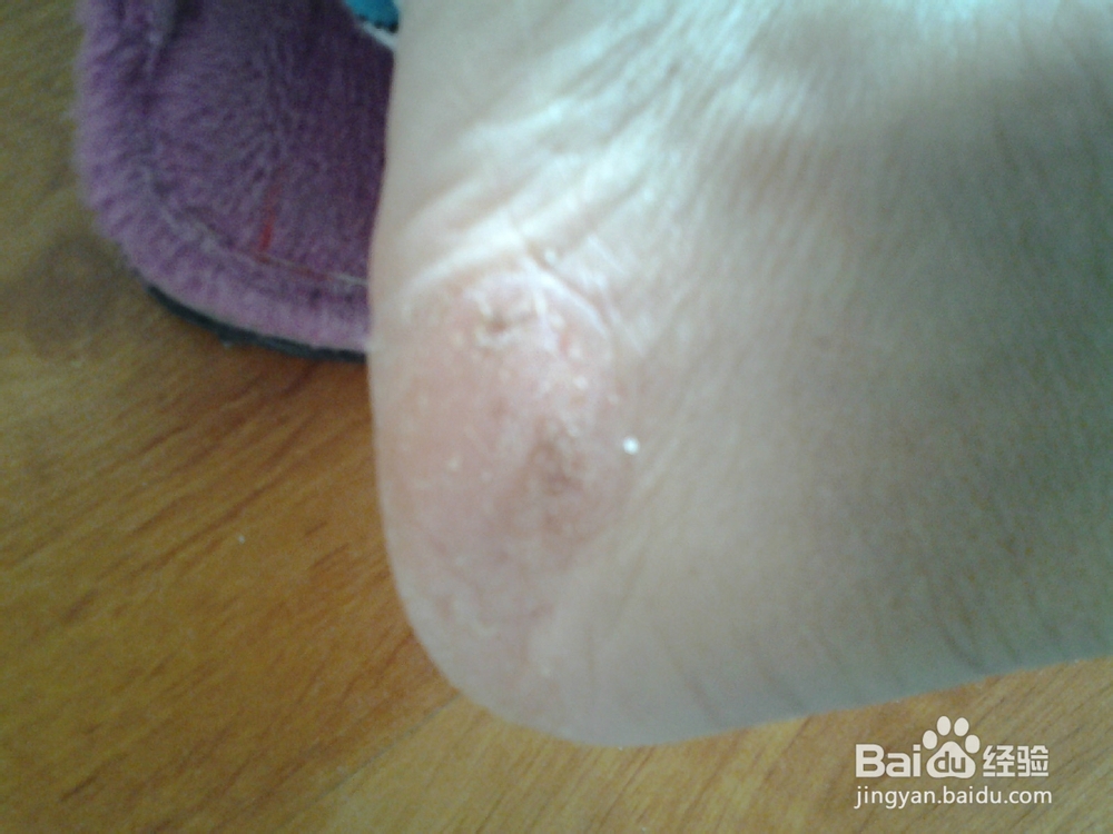 香蕉皮巧治皲裂