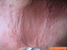 与荨麻疹一起生活 怎样治疗荨麻疹