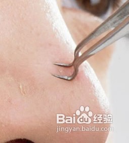 黑头怎么去,黑头怎么去
