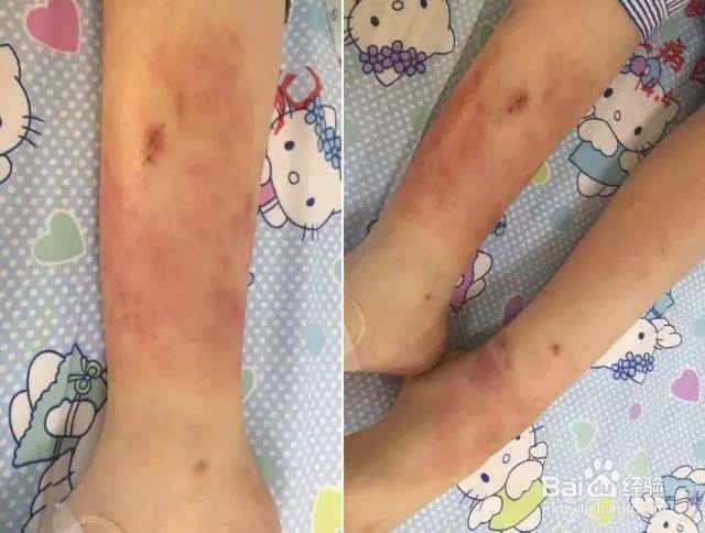 得了虫咬性皮炎该怎么办?