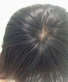 头发脱落严重怎么办