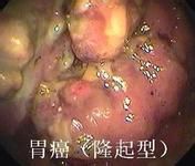 感染了幽门螺杆菌会有什么害处