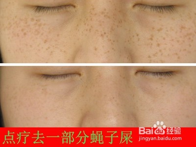 为什么脸上长蝇子屎/如何治去掉/有根除好办法吗