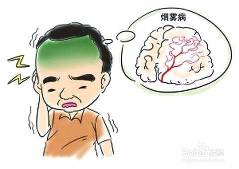 烟雾病有什么症状