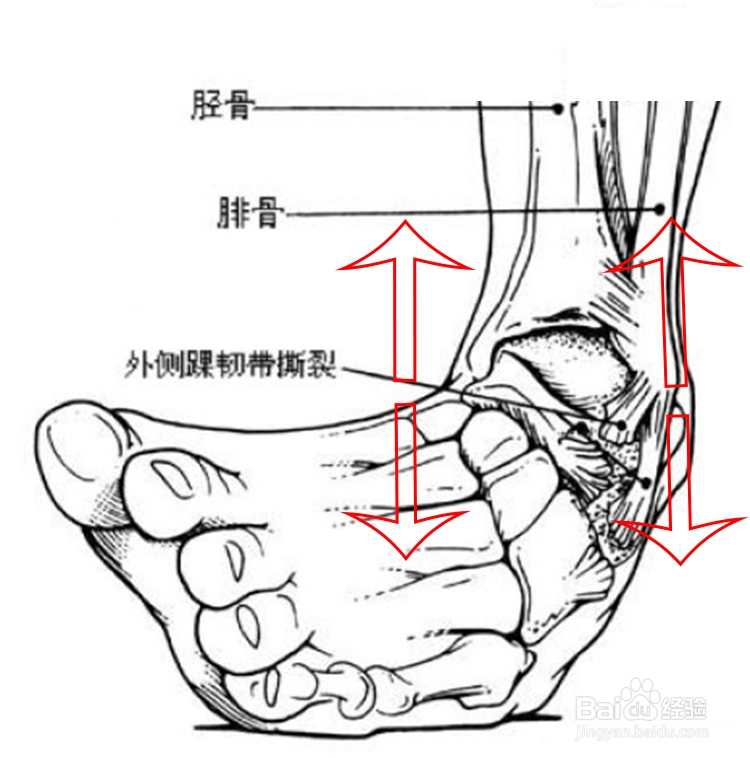 怎样摆脱习惯性脱臼——崴脚,崔希锋白话医学