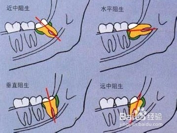 长智齿的了怎么办？