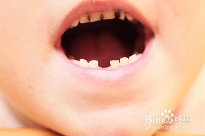 为什么牙齿需要矫正?