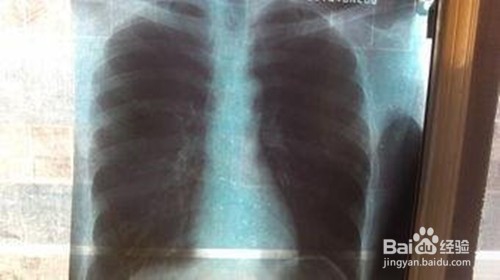农民肺与肺结核有哪些互相鉴别？