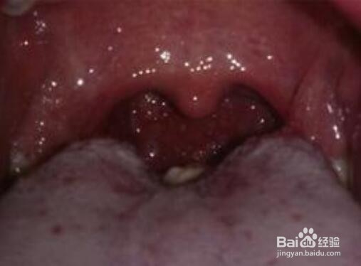 幼儿食物倒流处理方法