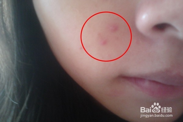 如何用PS去除脸上的痘痘