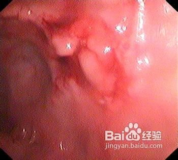 胃出血的危害有哪些