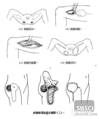 窦道型褥疮的治疗方法