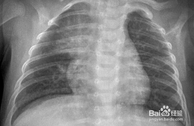 家里的宝宝经常发高烧怎么办