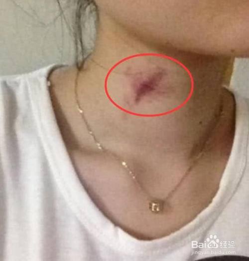 怎么遮住脖子上的草莓