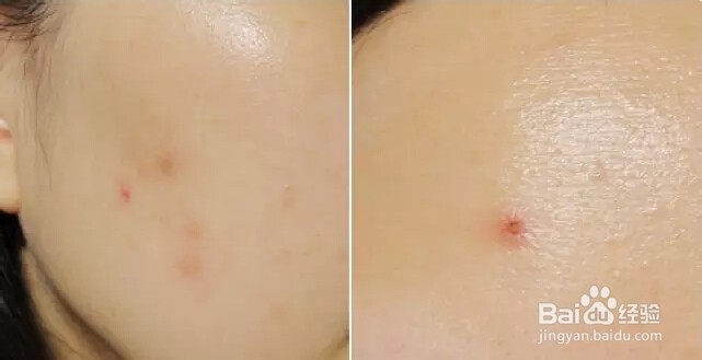 长痘痘怎么化妆完美遮瑕不留痕!