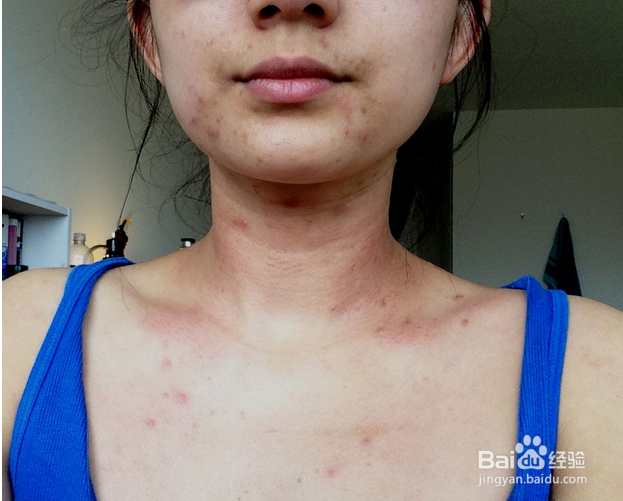 夏天保护颈椎的注意事项