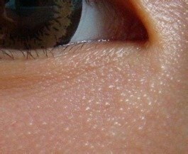 怎么快速去除脂肪粒